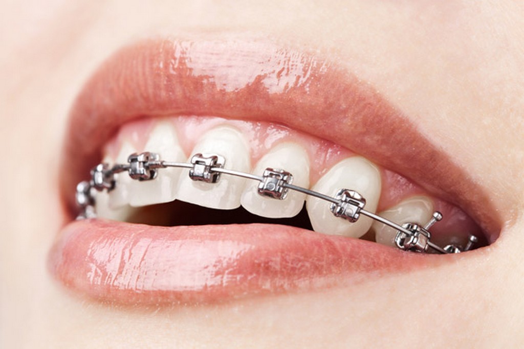 Aparato ortodoncia