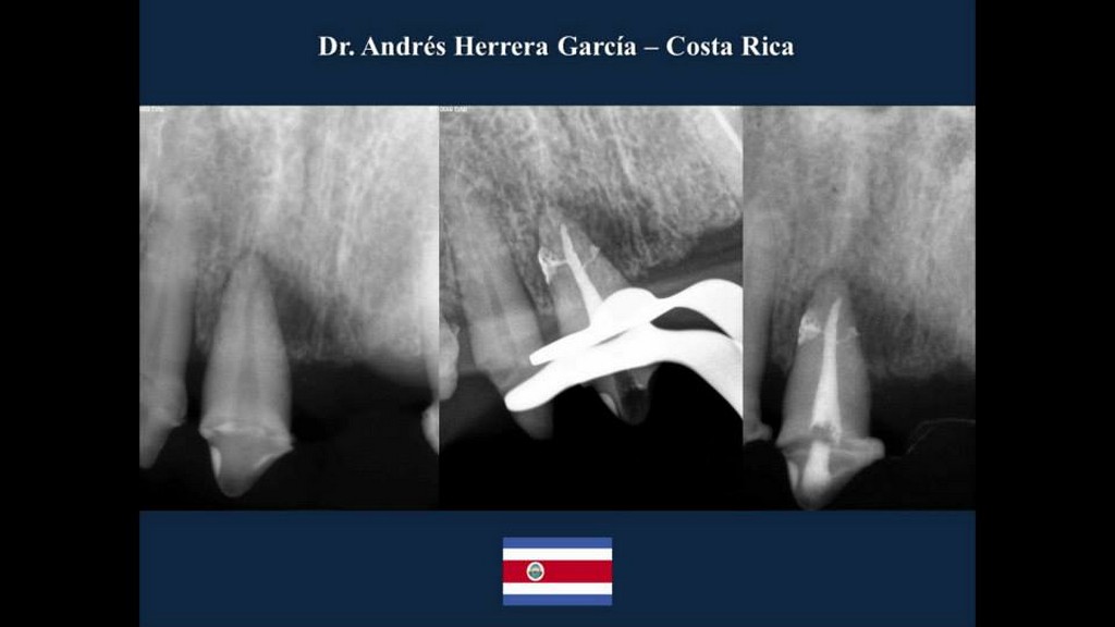 Caso 1 endodoncia