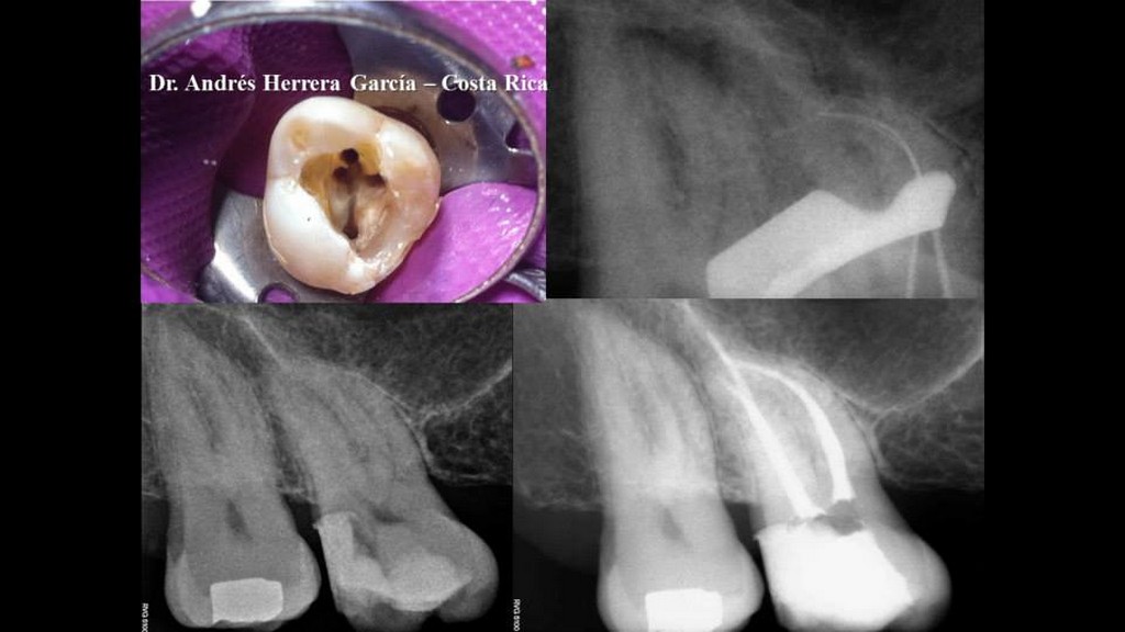 Caso 2 endodoncia