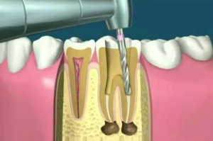 Perforación de diente