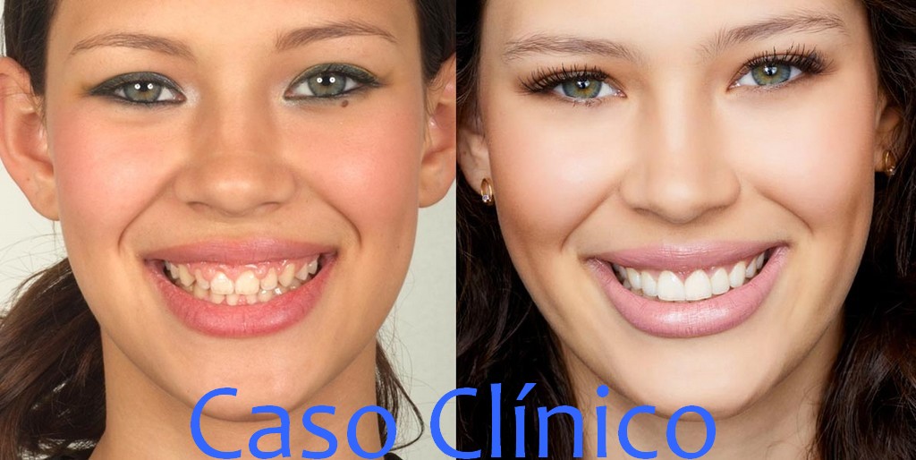 antes y despues carillas porcelana