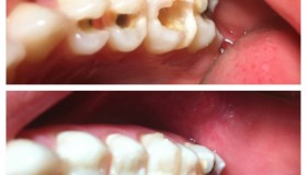 Restauraciones dentales estéticas