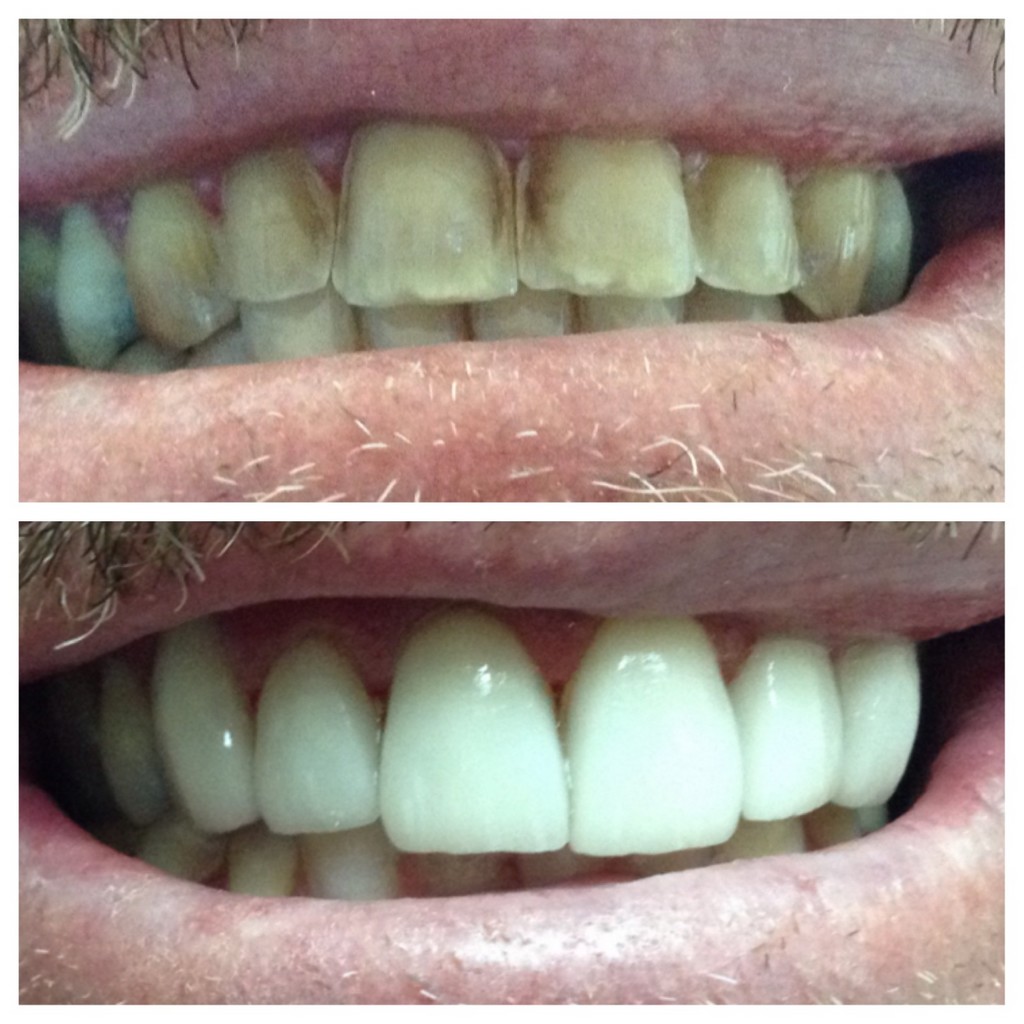 antes y despues
