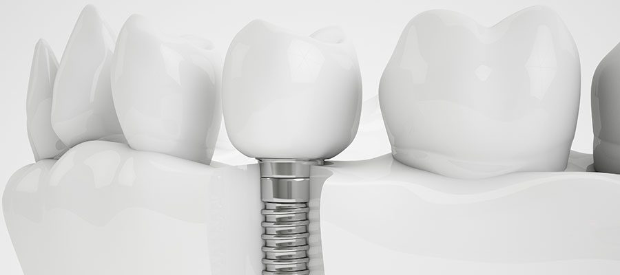 Implantes dentales en Costa Rica